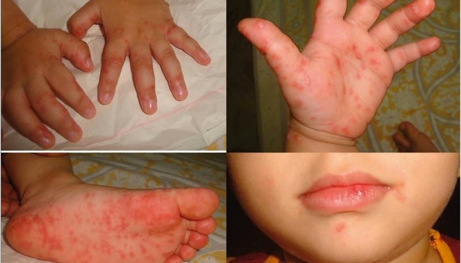 Hand Foot Mouth Disease Rash Symptoms Infoupdate